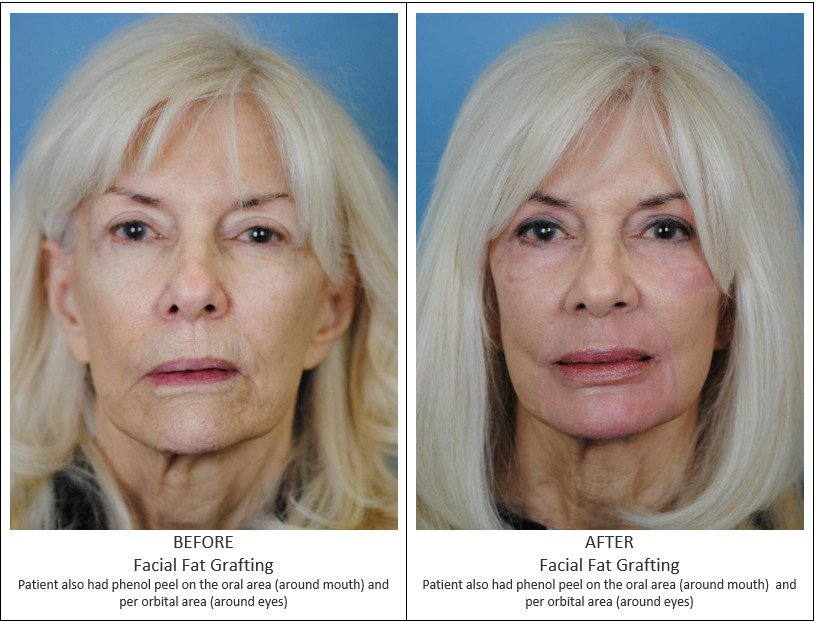 Before and After Treatment Photos - Facial Fat Grafting - female patient, front view. Patient also have phenol peel on the oral area (around mouth) and per orbital area (around eyes)