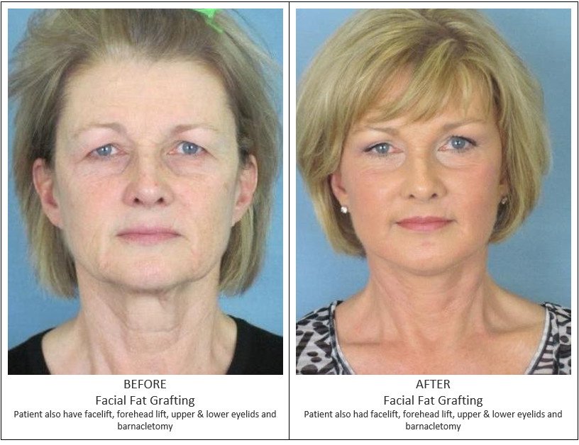 Before and After Treatment Photos - Facial Fat Grafting - female patient, front view. Patient also have facelift, forehead lift, upper and lower eyelids and barnacletomy