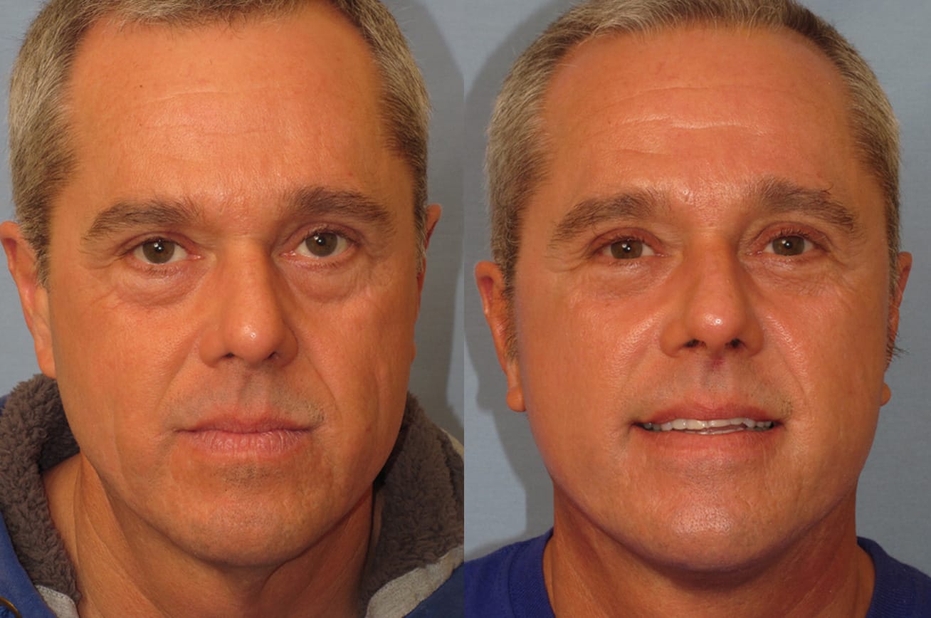 male facelift patient results