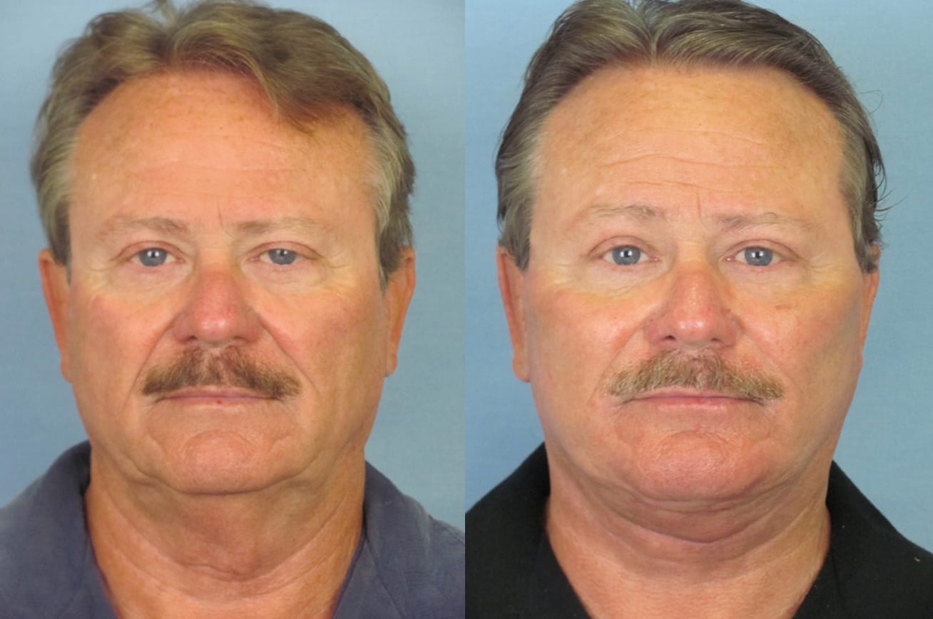 male facelift patient results