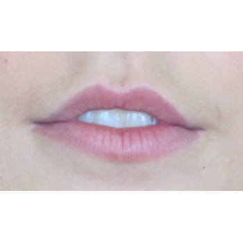 Dermal Fillers Before and After | Thomas Funcik MD