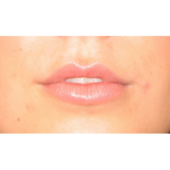 Dermal Fillers Before and After | Thomas Funcik MD