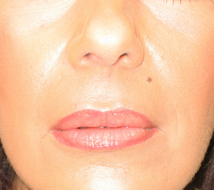 Charleston Dermal Fillers