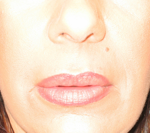 Charleston Dermal Fillers