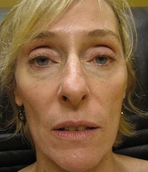 Sculptra Before and After | Thomas Funcik MD