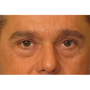 Sculptra Before and After | Thomas Funcik MD