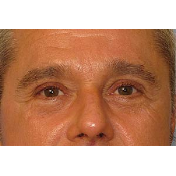 Sculptra Before and After | Thomas Funcik MD