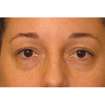 Sculptra Before and After | Thomas Funcik MD
