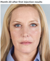 Sculptra Before and After | Thomas Funcik MD