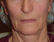 Sculptra Before and After | Thomas Funcik MD