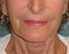 Sculptra Before and After | Thomas Funcik MD