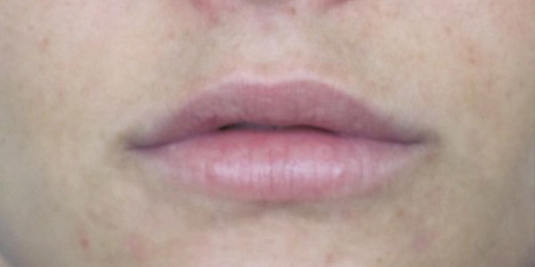 Silicone Lips Before and After | Thomas Funcik MD