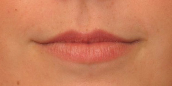 Silicone Lips Before and After | Thomas Funcik MD