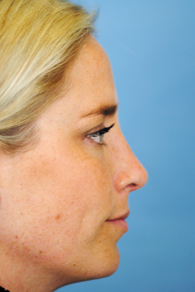 Rhinoplasty Before and After | Thomas Funcik MD