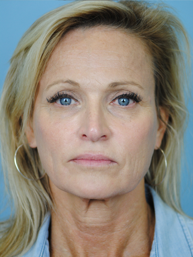 Custom Facelift, Charleston Facial Plastic Surgery