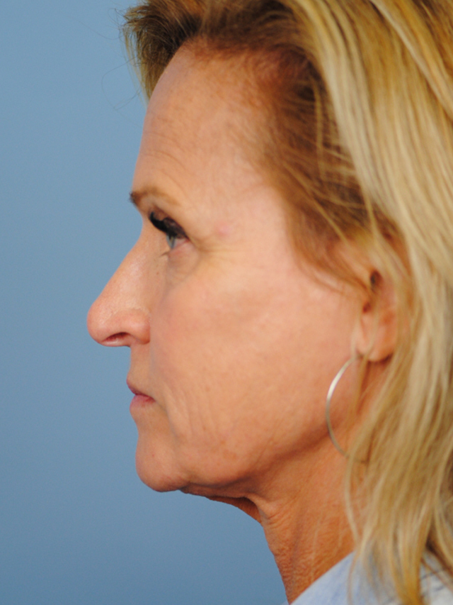 Charleston Custom Lift Facelift Before and After | Thomas Funcik MD