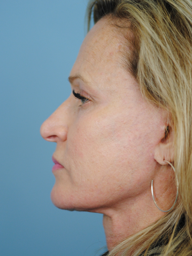 Charleston Custom Lift Facelift Before and After | Thomas Funcik MD