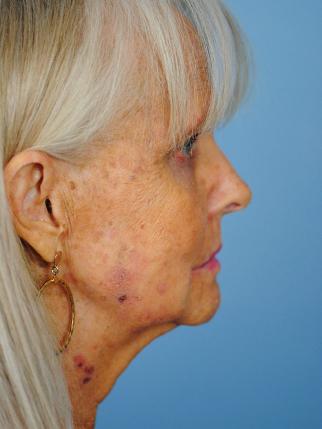 Charleston Custom Lift Facelift Before and After | Thomas Funcik MD