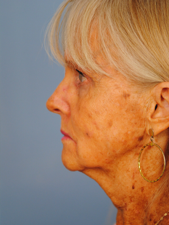 Charleston Custom Lift Facelift Before and After | Thomas Funcik MD