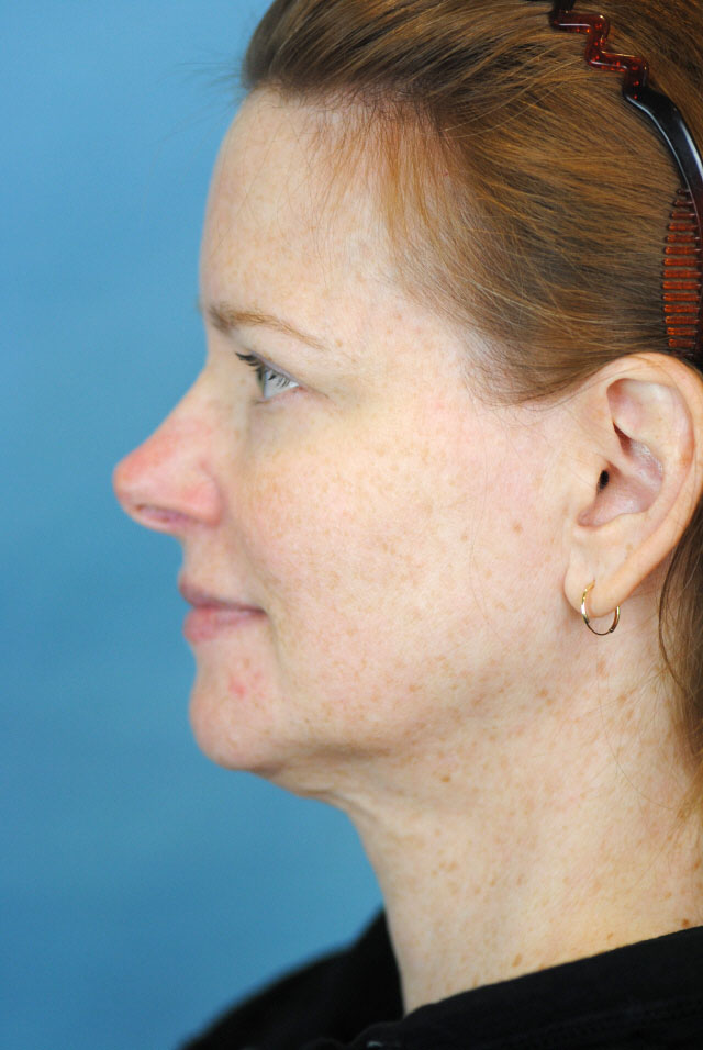 Charleston Custom Lift Facelift Before and After | Thomas Funcik MD