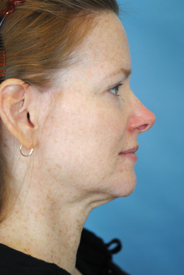 Charleston Custom Lift Facelift Before and After | Thomas Funcik MD