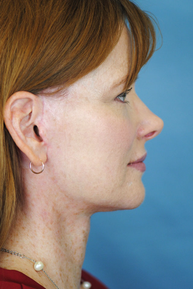 Charleston Custom Lift Facelift Before and After | Thomas Funcik MD