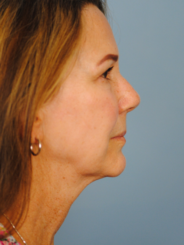 Charleston Custom Lift Facelift Before and After | Thomas Funcik MD