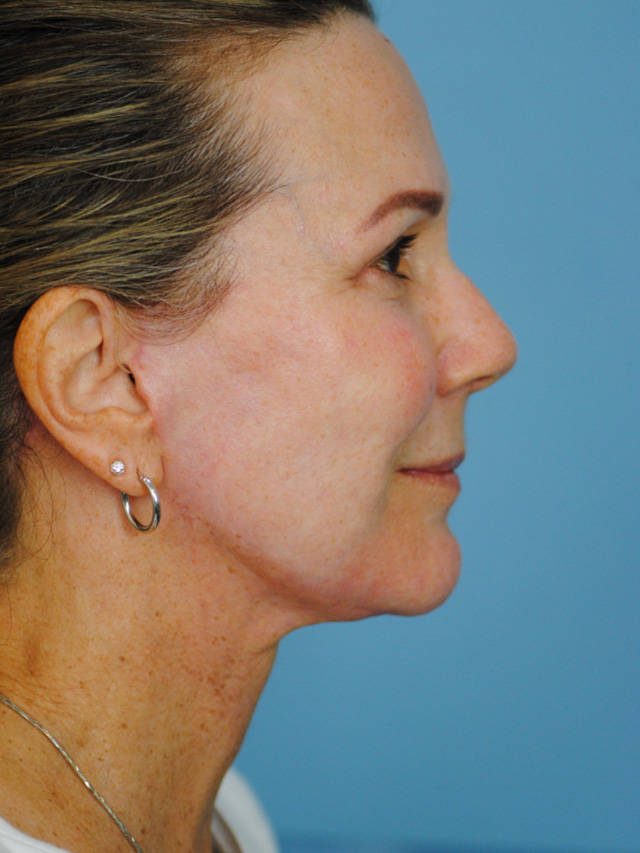 Charleston Custom Lift Facelift Before and After | Thomas Funcik MD