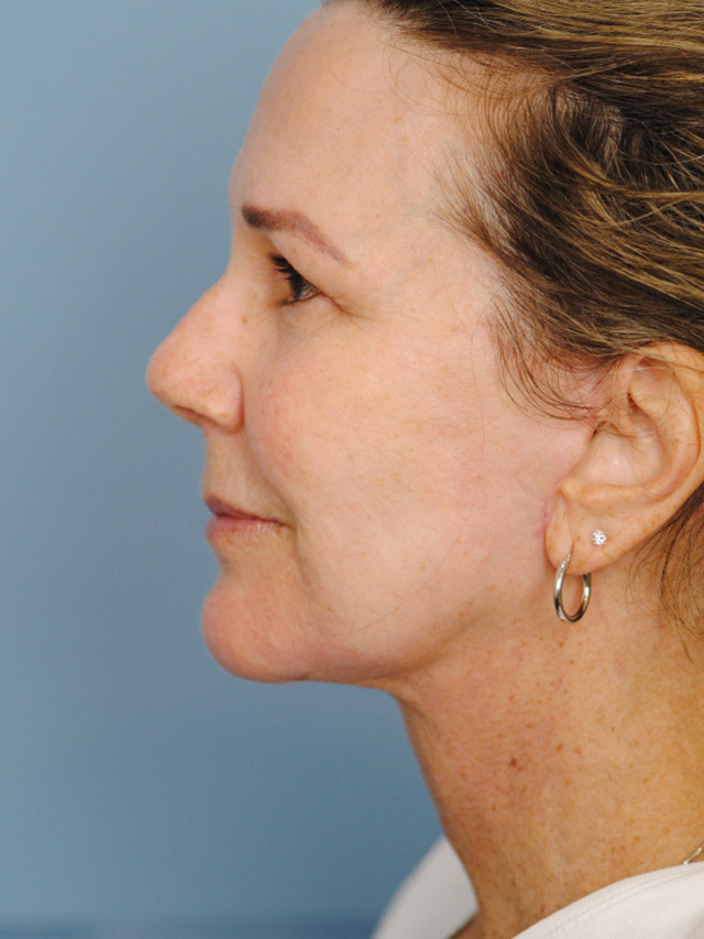 Charleston Custom Lift Facelift Before and After | Thomas Funcik MD