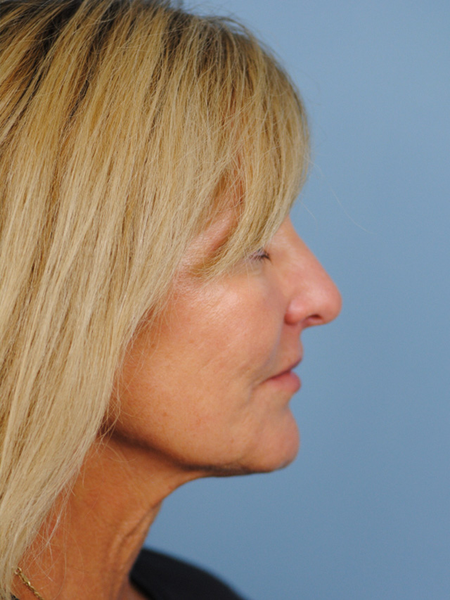 Charleston Custom Lift Facelift Before and After | Thomas Funcik MD