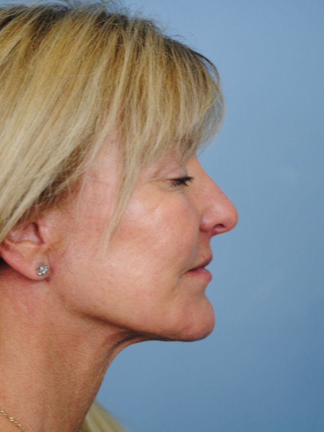 Charleston Custom Lift Facelift Before and After | Thomas Funcik MD