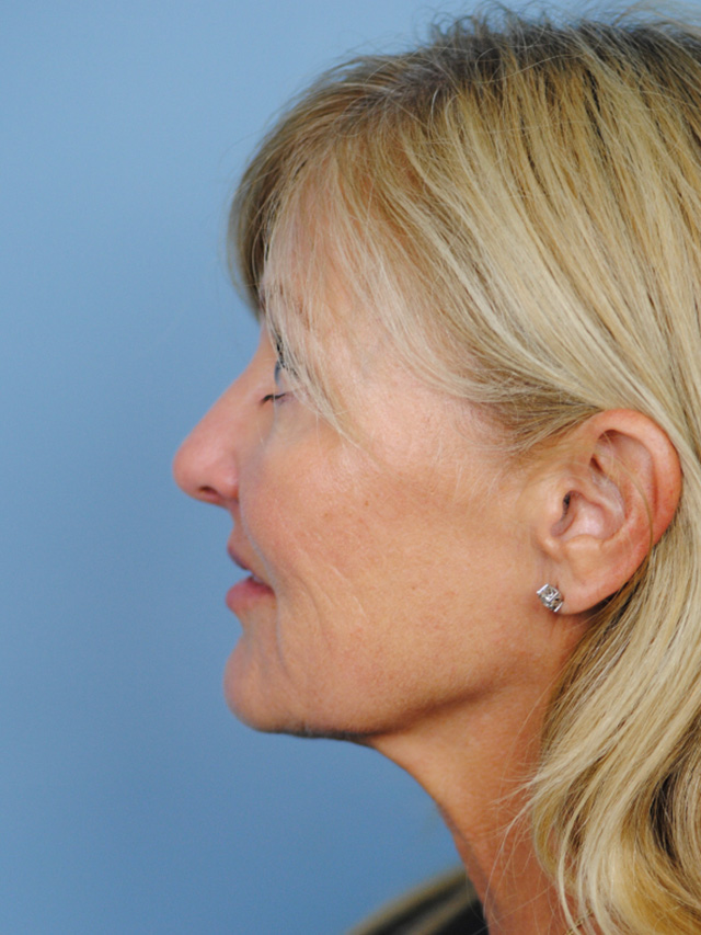 Charleston Custom Lift Facelift Before and After | Thomas Funcik MD