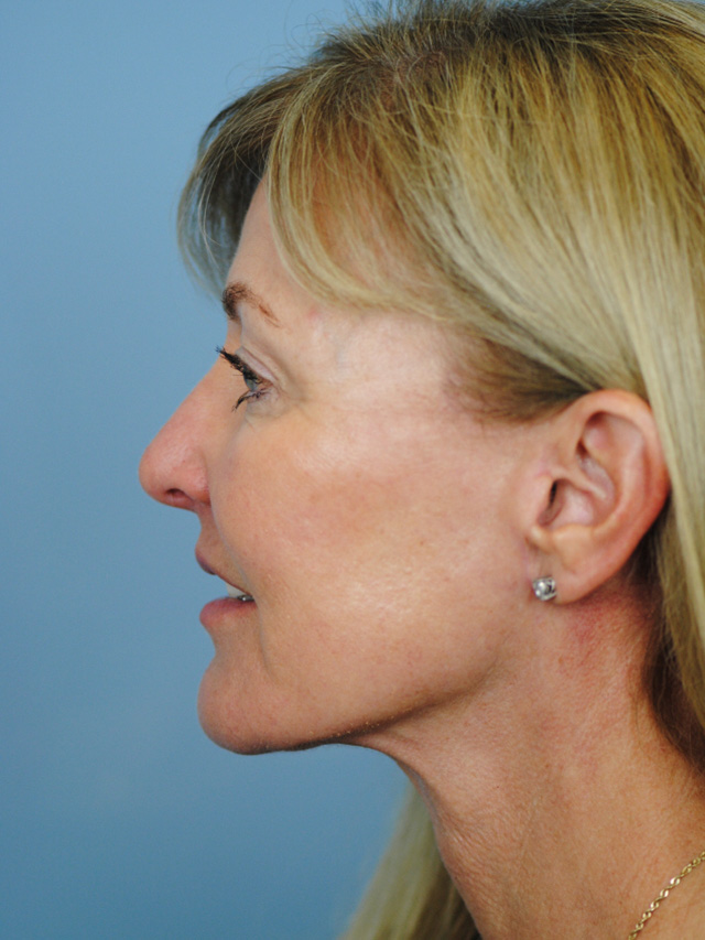 Charleston Custom Lift Facelift Before and After | Thomas Funcik MD