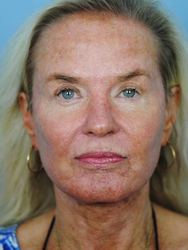 Charleston Custom Lift Facelift Before and After | Thomas Funcik MD