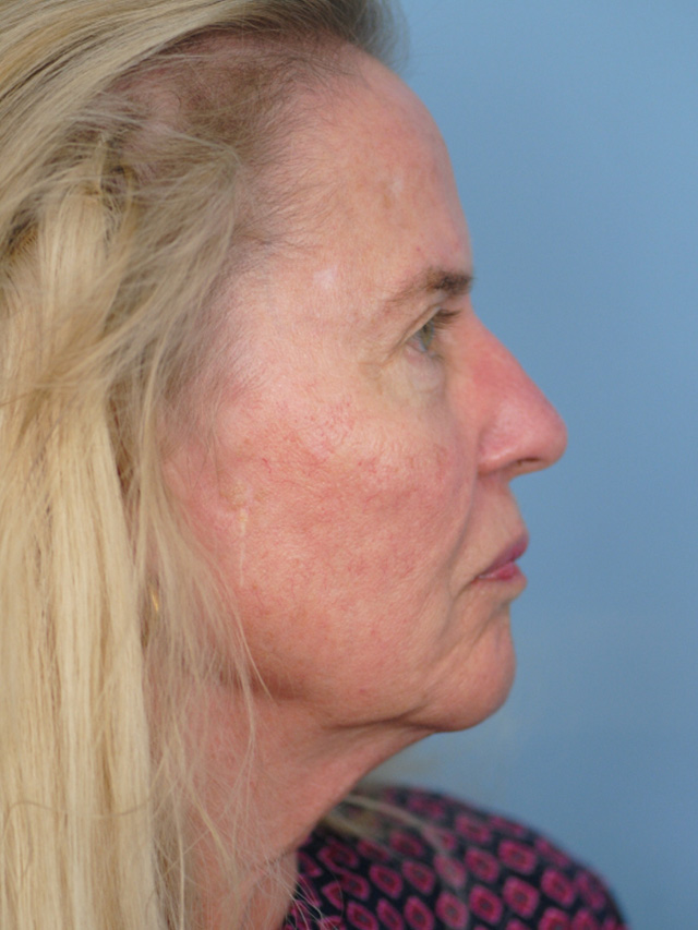 Charleston Custom Lift Facelift Before and After | Thomas Funcik MD