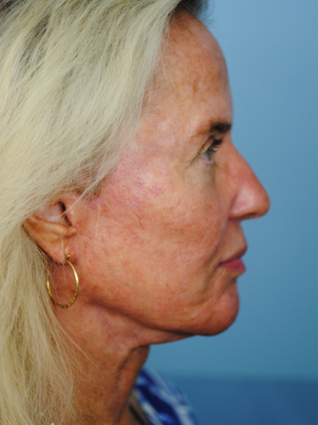 Charleston Custom Lift Facelift Before and After | Thomas Funcik MD