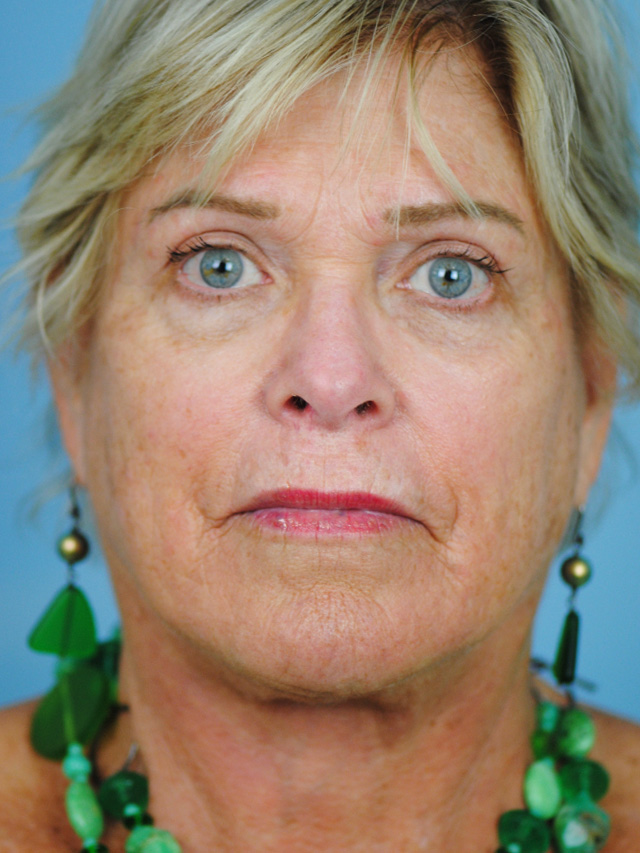 Charleston Custom Lift Facelift Before and After | Thomas Funcik MD