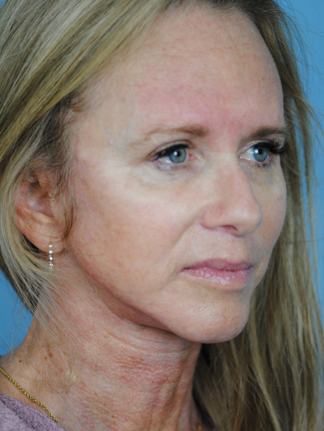 Charleston Custom Lift Facelift Before and After | Thomas Funcik MD