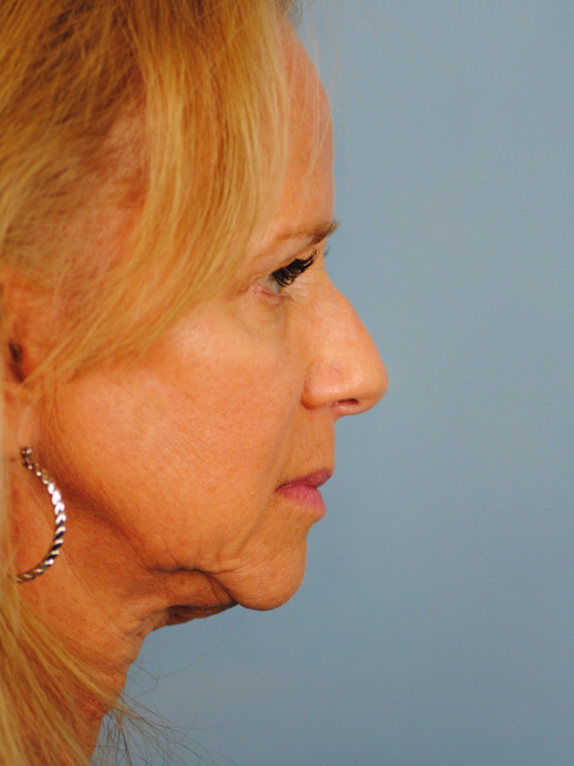 Charleston Custom Lift Facelift Before and After | Thomas Funcik MD