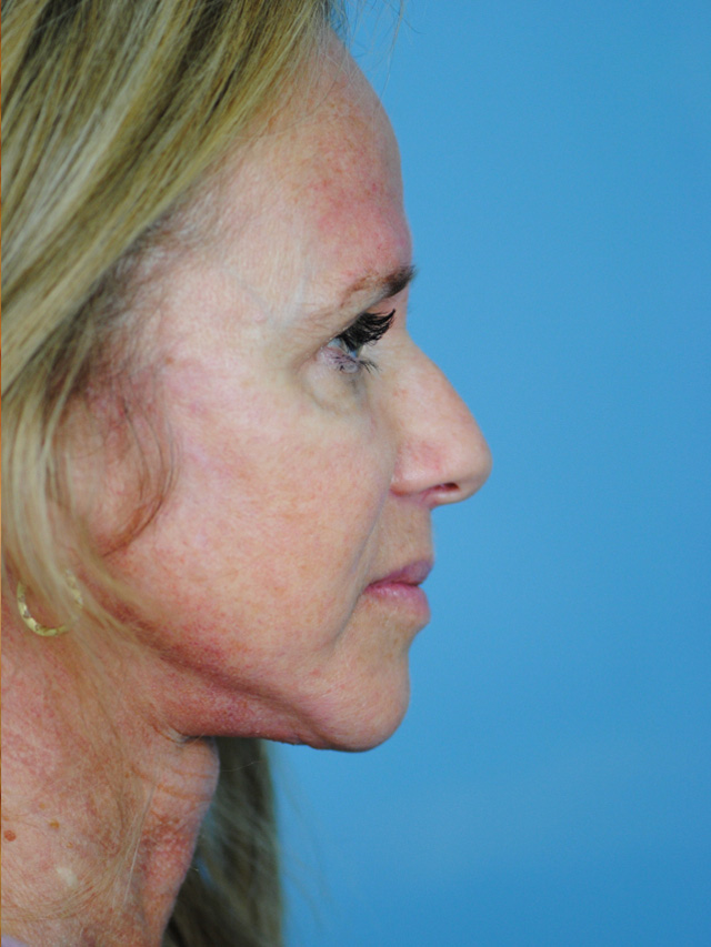 Charleston Custom Lift Facelift Before and After | Thomas Funcik MD