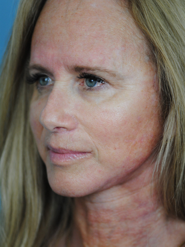 Charleston Custom Lift Facelift Before and After | Thomas Funcik MD