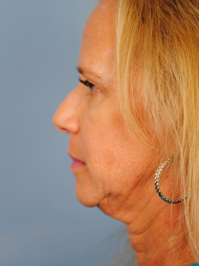 Charleston Custom Lift Facelift Before and After | Thomas Funcik MD