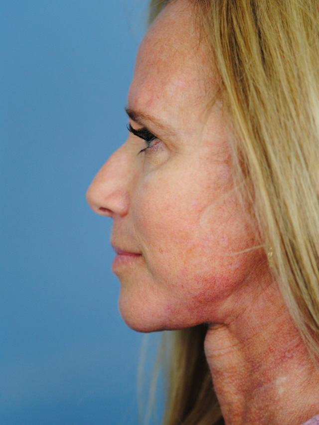 Charleston Custom Lift Facelift Before and After | Thomas Funcik MD