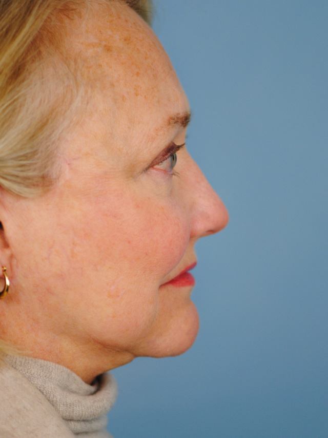 Charleston Custom Lift Facelift Before and After | Thomas Funcik MD