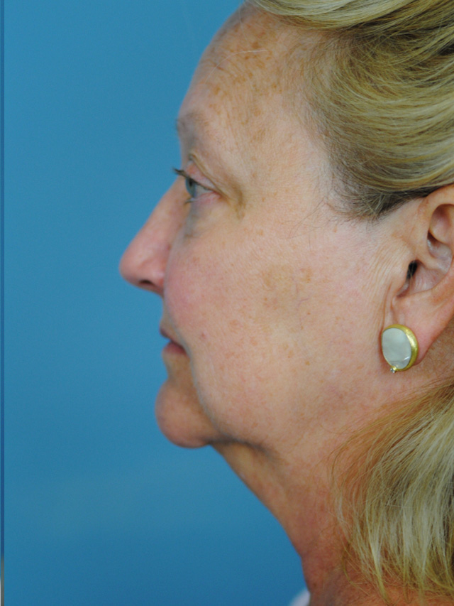 Charleston Custom Lift Facelift Before and After | Thomas Funcik MD