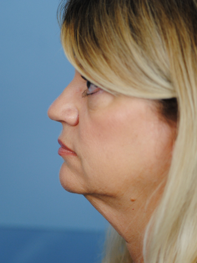 Charleston Custom Lift Facelift Before and After | Thomas Funcik MD