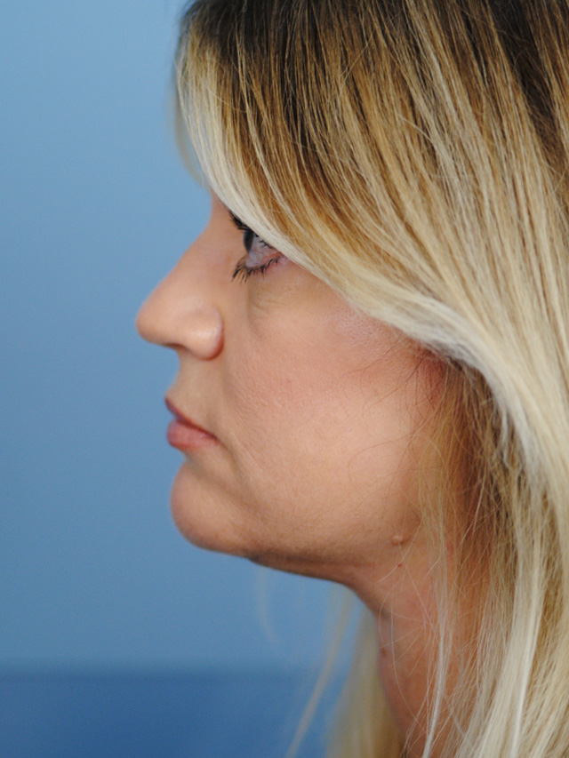 Charleston Custom Lift Facelift Before and After | Thomas Funcik MD