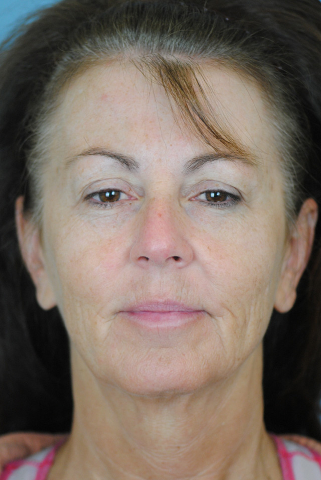 Charleston Custom Lift Facelift Before and After | Thomas Funcik MD