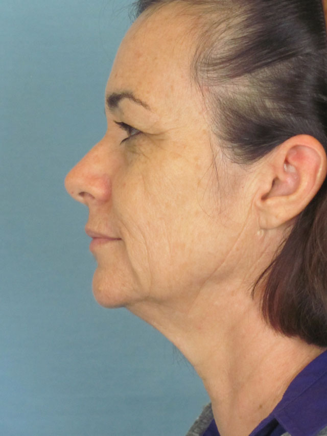 Charleston Custom Lift Facelift Before and After | Thomas Funcik MD