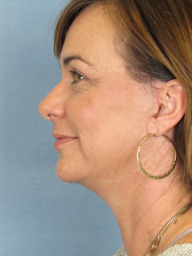 Charleston Custom Lift Facelift Before and After | Thomas Funcik MD